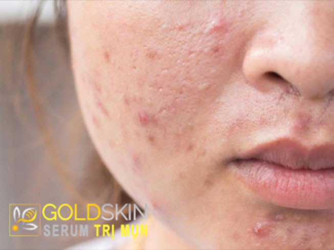 Có cách nào khắc phục tình trạng da mặt nhiều mụn và da bóng dầu không?