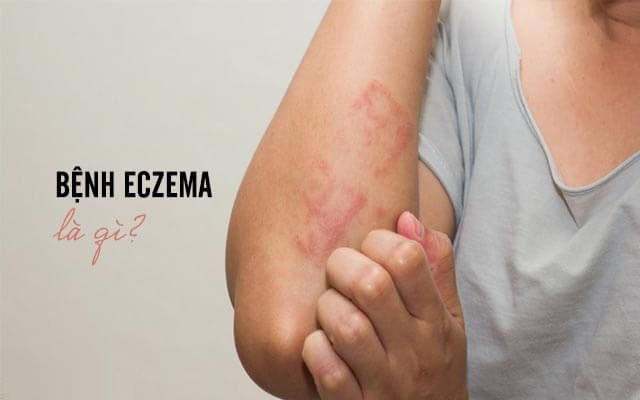 Bệnh Ezecma là gì?