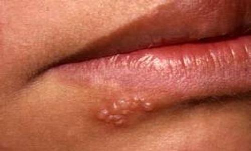 Mụn rộp trên môi là những nốt bị viêm loét khiến vùng da đó bị phồng rộp lên