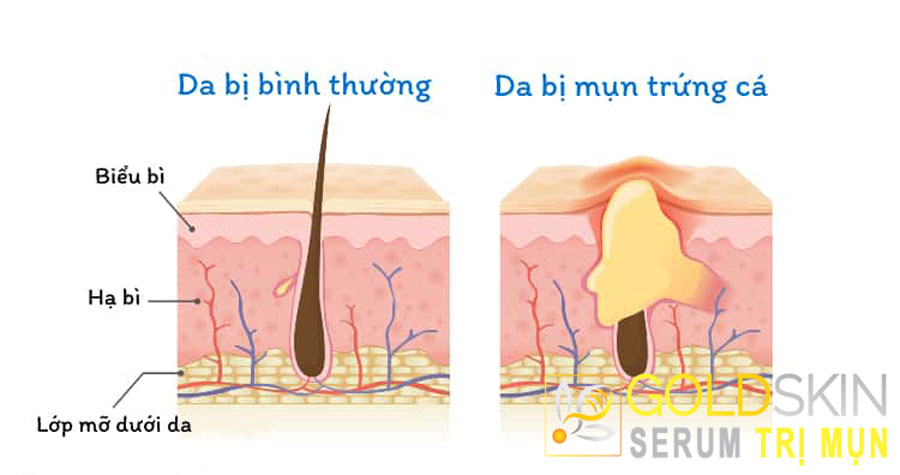 Nguyên nhân chính dẫn đến mụn là do sự tích tụ của bã nhờn, bụi bẩn, và vi khuẩn ở các lỗ chân lông