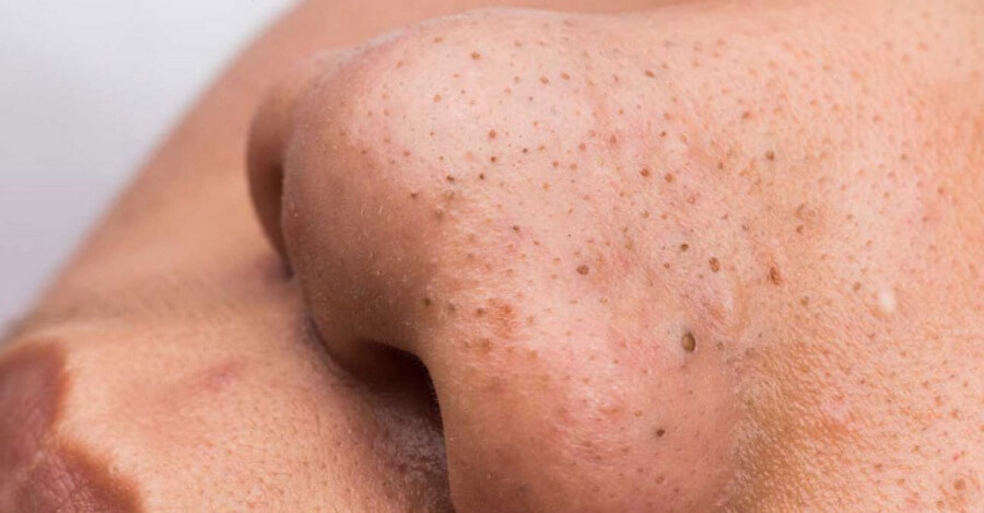 Vùng da mũi lại là thường xuất hiện mụn đầu đen phổ biến nhất
