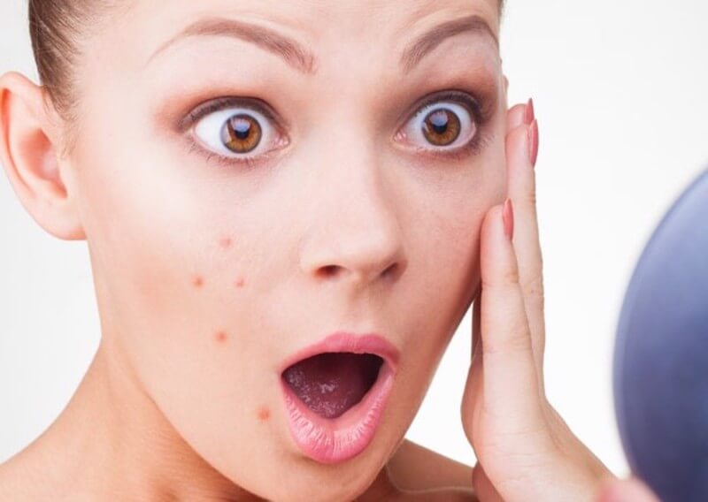 Lười rửa mặt là nguyên nhân lớn nhất gây ra tất cả các loại mụn, không chỉ ở mụn đầu đen